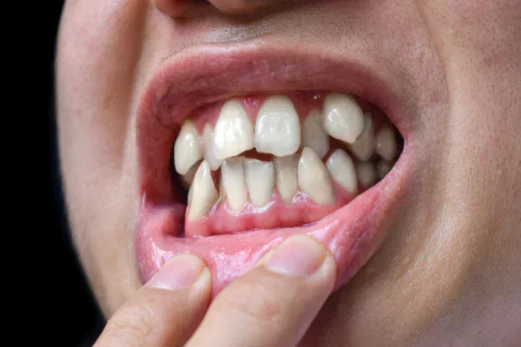 Una persona che mostra i denti storti.