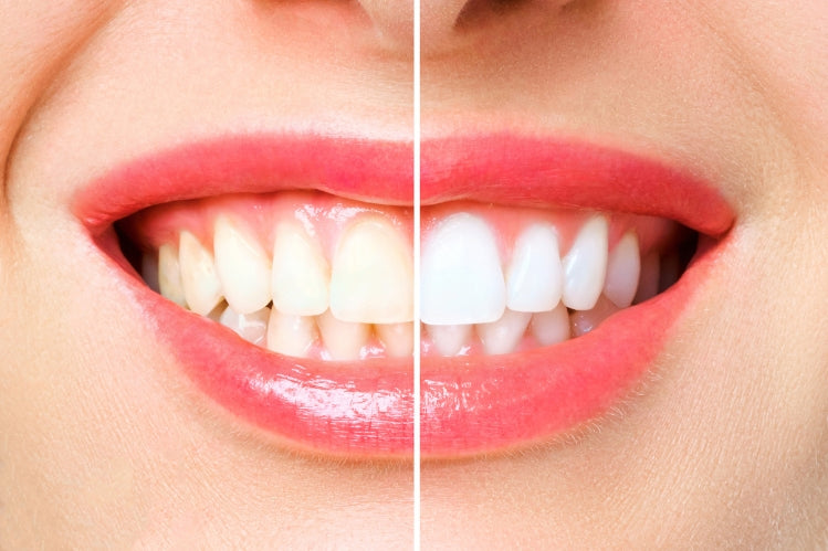 teeth whitening