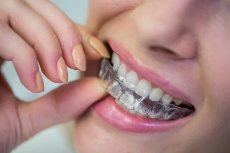 Allineatori trasparenti per denti affollati