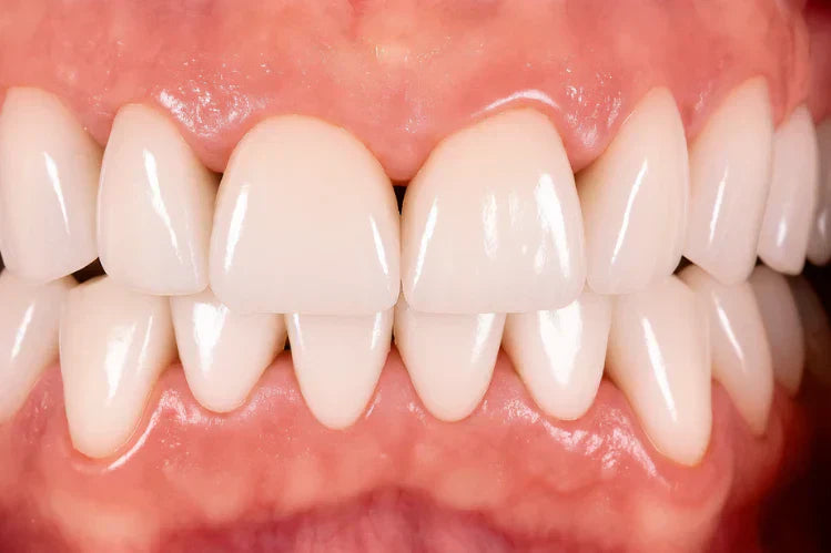 Un primo piano di come appaiono i triangoli neri tra i denti.