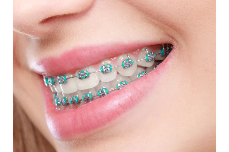 Immagine ravvicinata di una donna con l'apparecchio ortodontico blu.