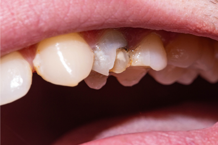 Un primo piano di un uomo che soffre di un dente scheggiato.