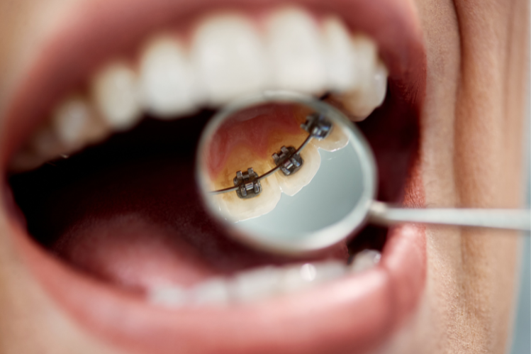 Una donna sorridente con un morso di classe I.