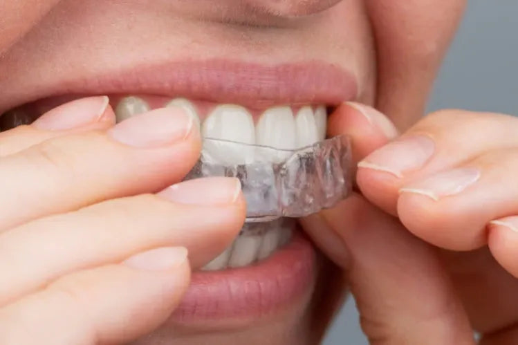 Una ragazza applica degli allineatori trasparenti per raddrizzare i denti a casa.