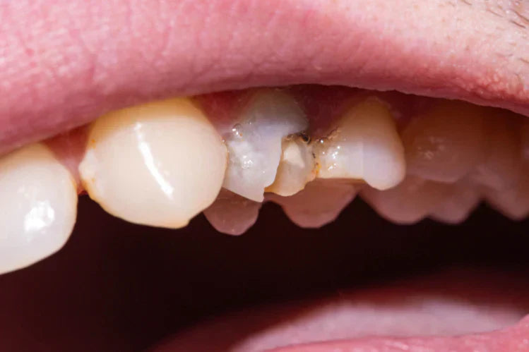 Immagine di un dente morto con lo smalto scheggiato.