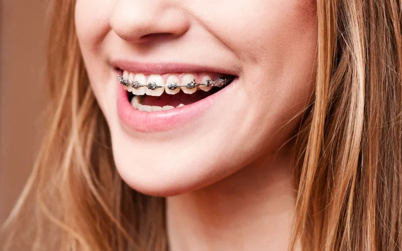 Una ragazza che sorride con apparecchi metallici