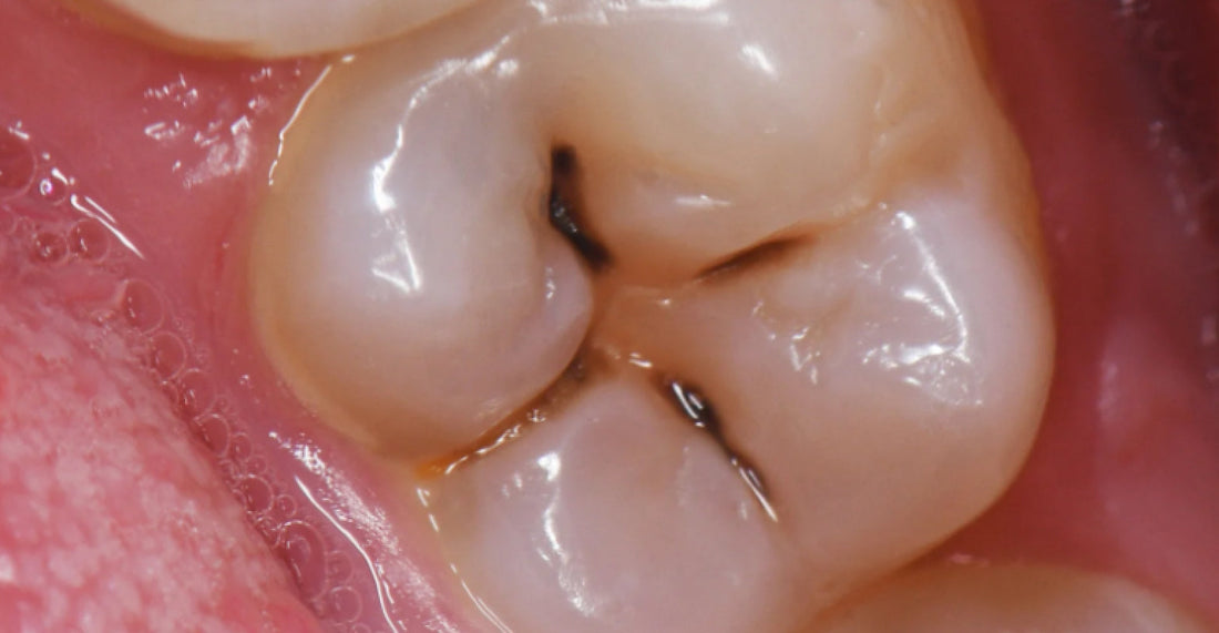  Immagine di un dente con una cavità