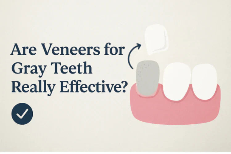 Illustrazione che mostra un dente grigio ricoperto da una faccetta dentale,