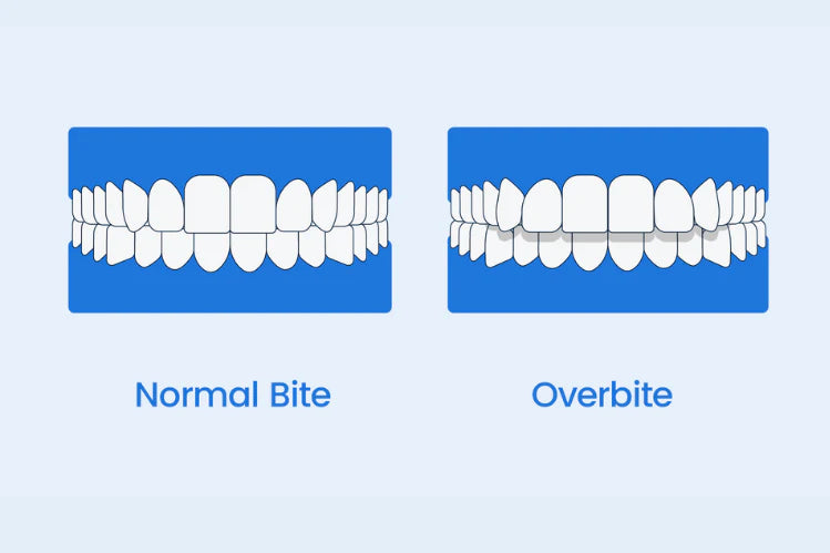 Illustrazione che mostra una normale occlusione dentale e una sovra-occlusione dentale affiancate.