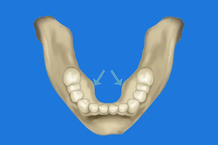 Torus mandibularis: comprendere le protuberanze ossee in bocca