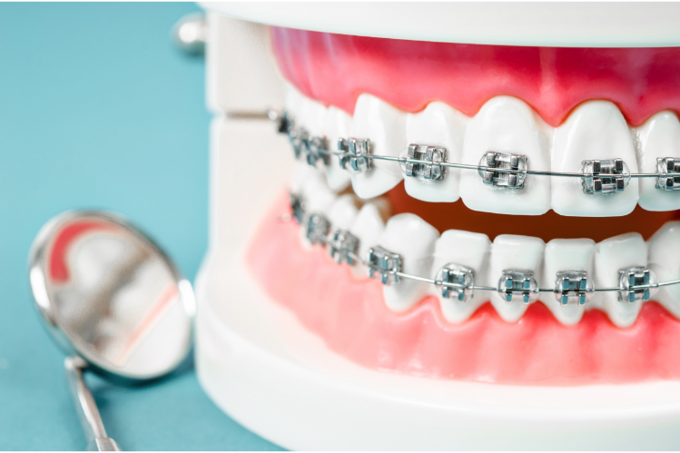 ortodontico si rompa o faccia male