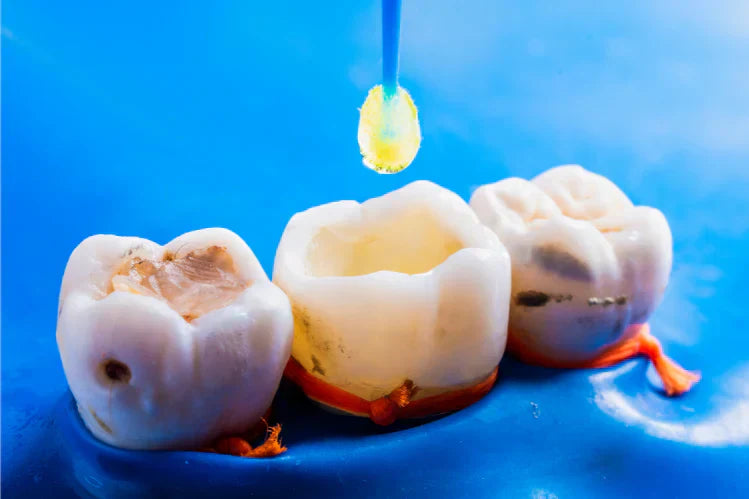 Otturazione dentale su un dente