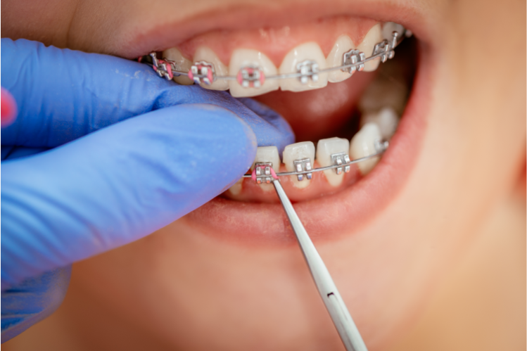 A person getting rubber bands fixed on the braces