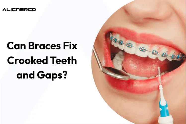 Una ragazza che indossa un apparecchio metallico colorato per raddrizzare i denti.