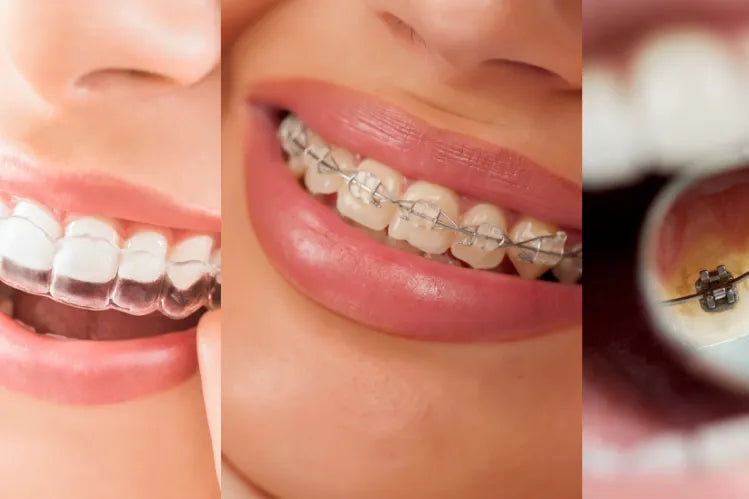 Un'immagine affiancata di diversi tipi di apparecchi ortodontici