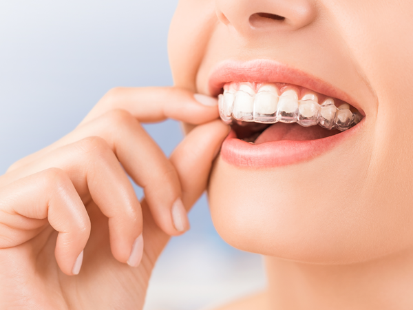 Ulteriori elementi di contenzione