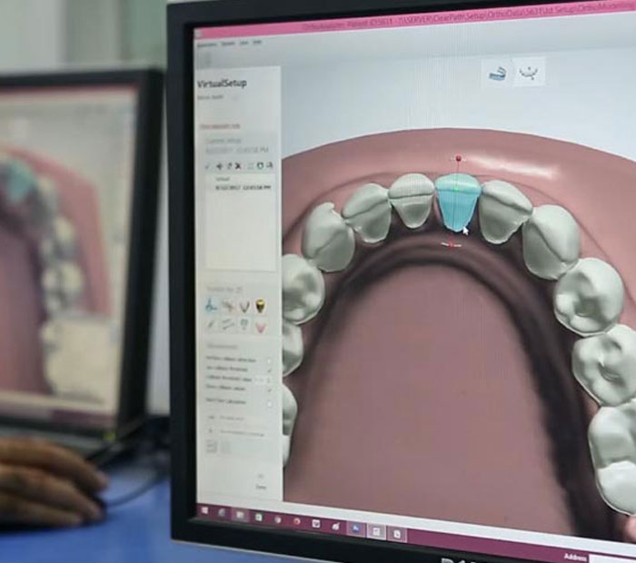 CouplesAdvantage - Allineatori trasparenti NightOnly